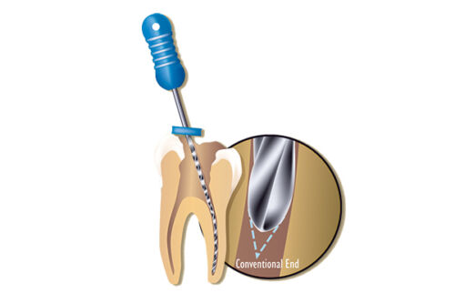 K Files Endodontic Instruments Premier Dental