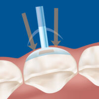 Premier Dental - Cure-Thru Clear Cervical Matrices