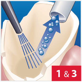 CompCore with Bonding Agent, Step 1 & 3