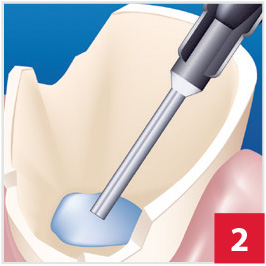 CompCore with Bonding Agent, Step 2