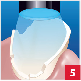 CompCore with Bonding Agent, Step 5