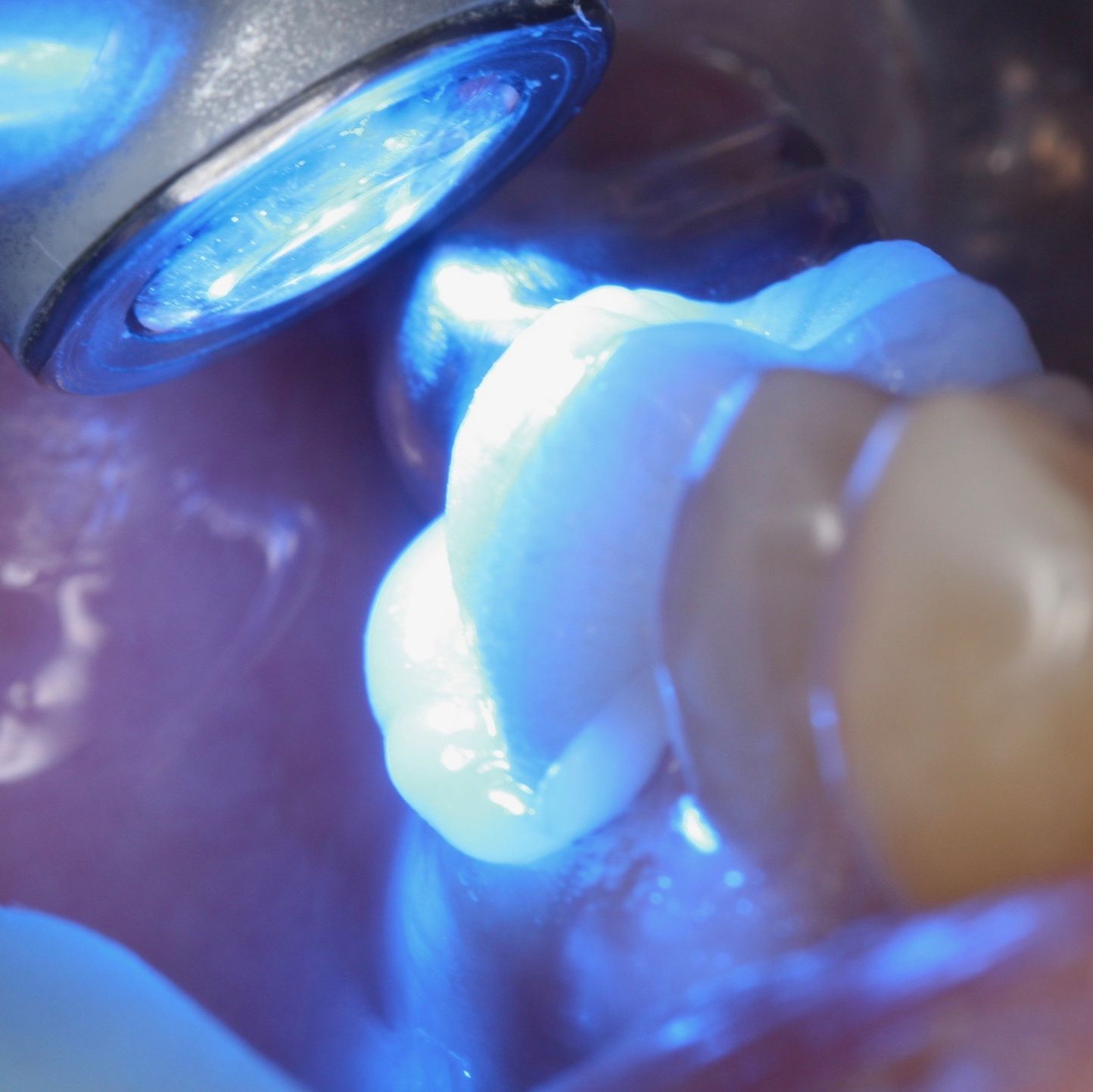 ZR-Cem - Zirconia Cementation Solution