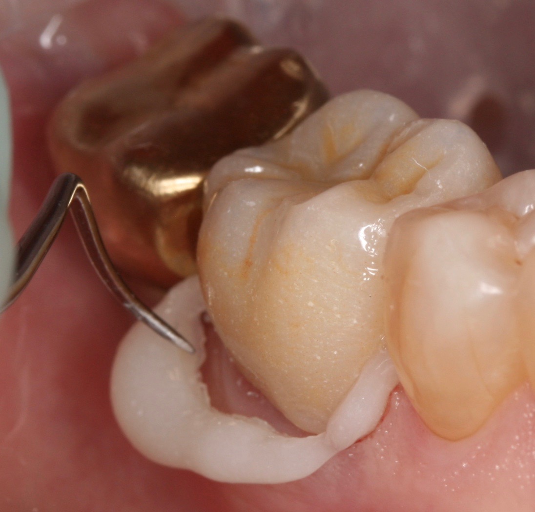 ZR-Cem - Zirconia Cementation Solution