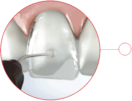 VeneerNow - Injection stalk for flowable composite