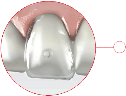 VeneerNow - Natural cervical line